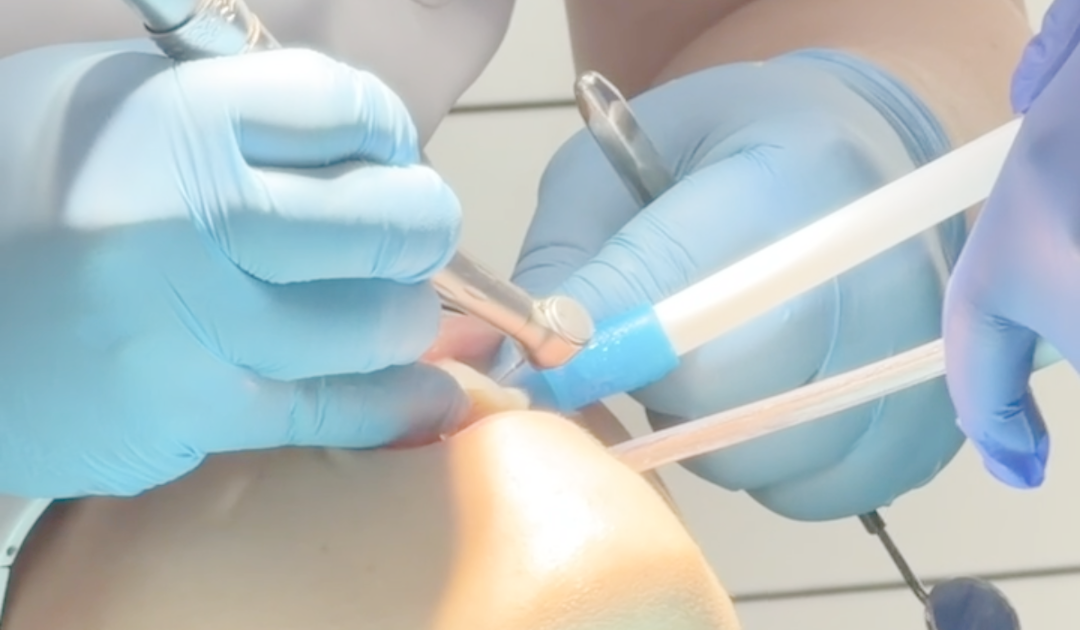 IPR between teeth for clear aligner treatment Jawology