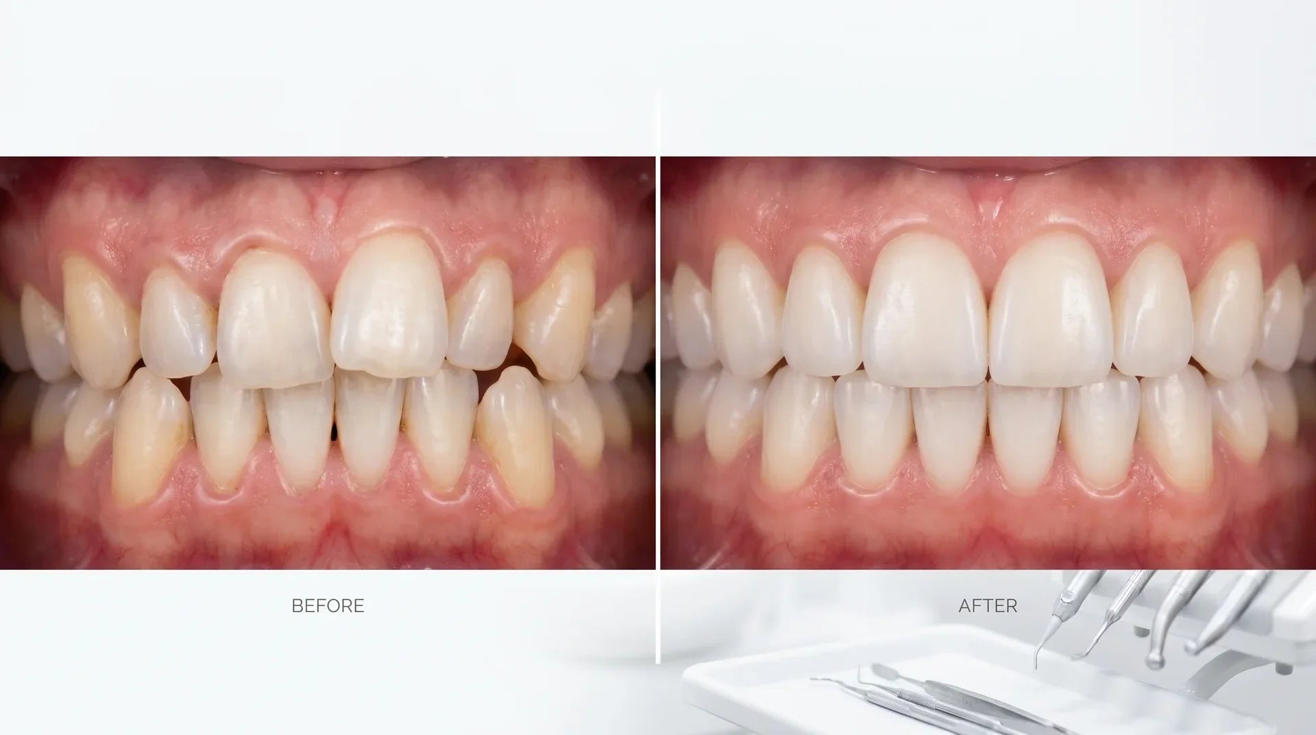 clear aligner treatment fixing crowded teeth before and after Jawology Australia